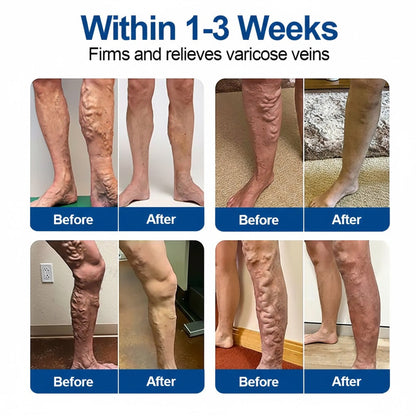 🇺🇸👨‍⚕️✅ JUXEK® Vein Ease Microneedle Patch — Visible Vein Reduction in 7 Days, No Clinic, No Compression Socks, Just Sleep ⚡
